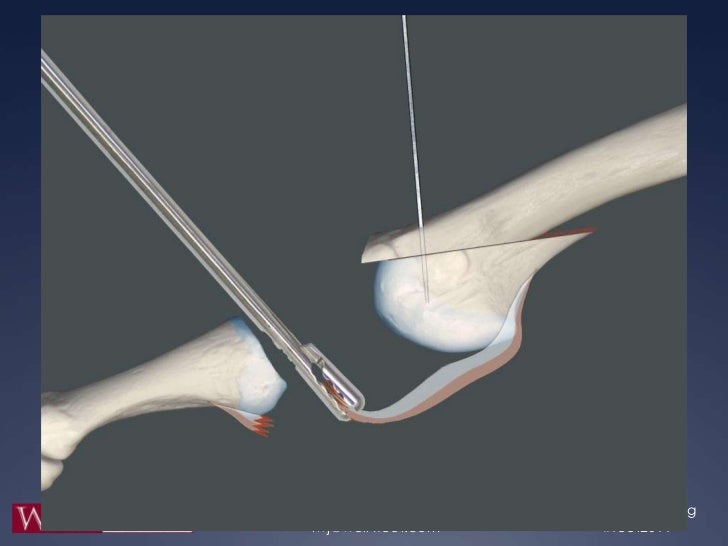 Dorsal Anatomic Plantar Plate Repair Dorsal Anatomic Plantar Plate Repair