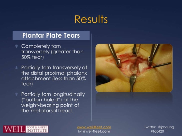 Dorsal Anatomic Plantar Plate Repair