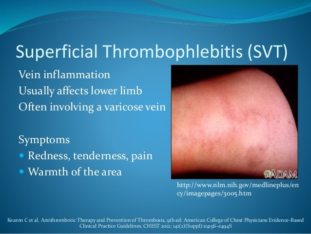Thrombophlebitis As Related To Deep Vein Thrombosis Pictures