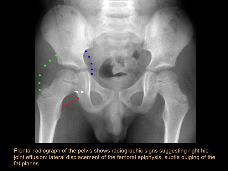 Hip joint effusion in adults
