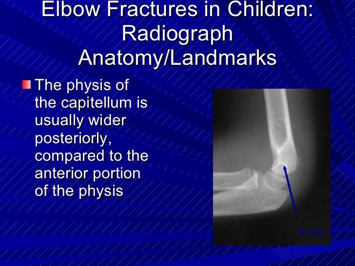 icd 10 code closed supracondylar fracture elbow
