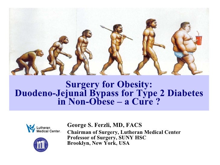 Metabolic surgery for type 2 diabetes pdf ingles