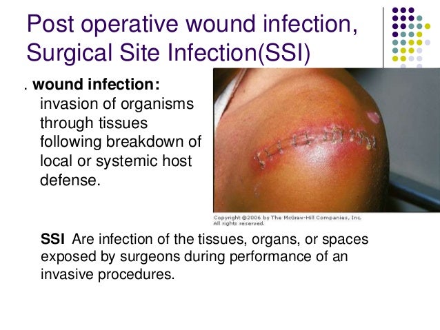 FAQ's about Surgical Site Infections - CDC
