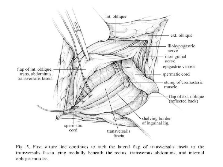 Surgical Options In The Management Of Hernia Repair