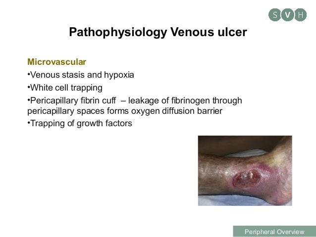 Assessment of leg ulcers and advances in endovascular treatment