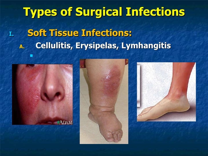 Surgical infections