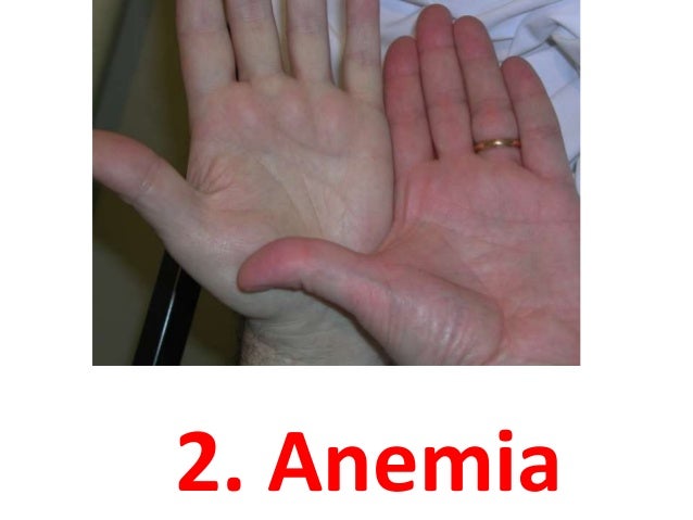 Cancer colon accutane cause