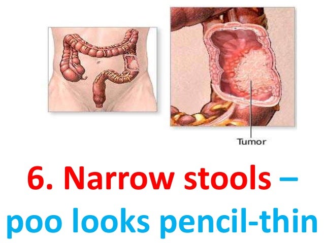 Constipation Narrow Stools ibs and narrow stools impact of ibs and chronic Constipation Narrow Stools ibs and narrow stools impact of ibs and chronic