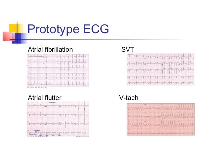 atrial flutter vs sinus tachycardia atrial flutter vs sinus tachycardia