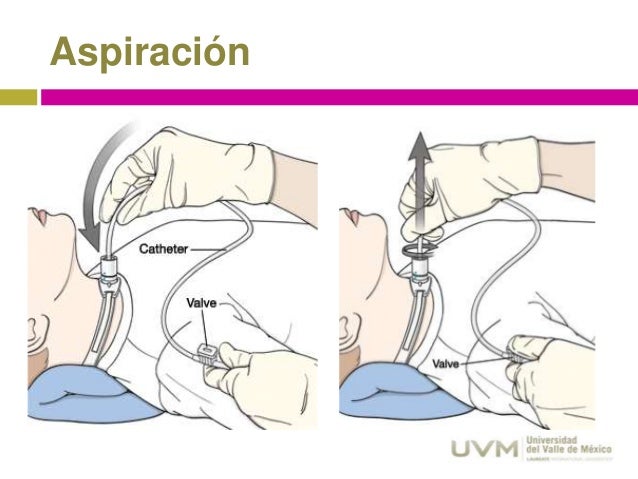 cuidados-de-traqueostom-a-pedi-trica