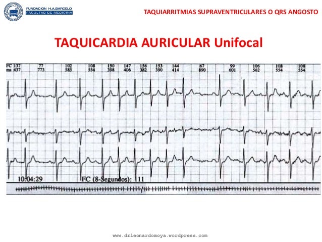Enfermer@ en Urgencias y UCI : Manejo de Taquiarritmias en Enfermer@ en Urgencias y UCI : Manejo de Taquiarritmias en