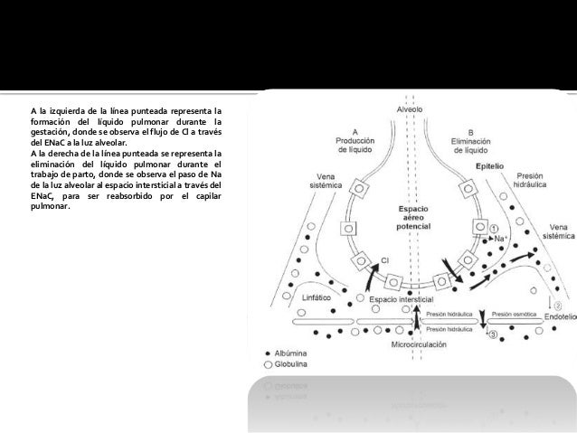 Taquipnea transitoria del recien nacido