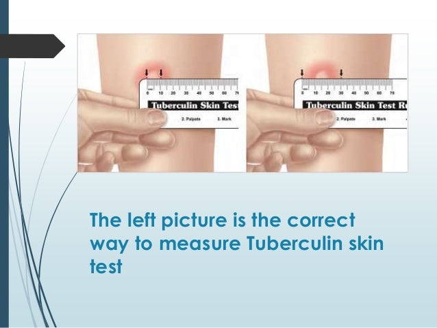 Test pictures tb positive skin Test pictures tb positive skin
