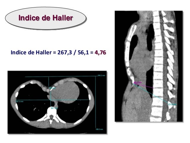 Resultado de imagen para indice de haller
