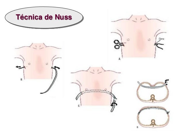 Resultado de imagen para tecnica de nuss