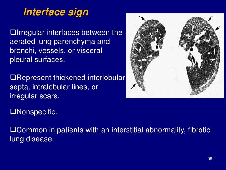 Pleural Thickening Lung