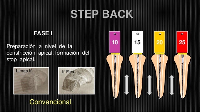 Técnica Híbrida de Instrumentación Manual. (Doble Conicidad)