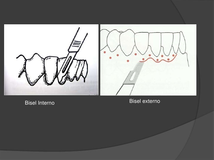 Gingivectomia A Bisel ...