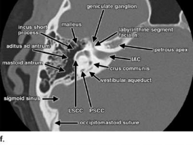 labeled internal auditory canal mri
