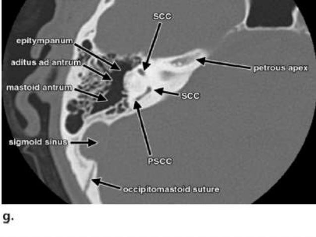 IMAGING OF TEMPORAL BONE