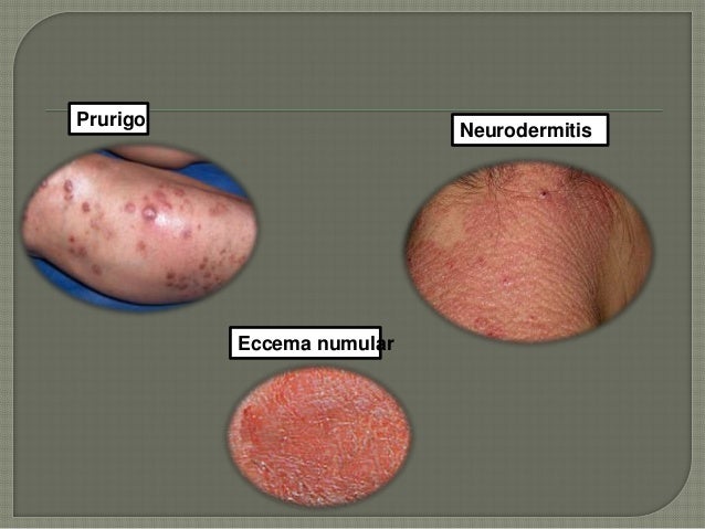 La psoriasis solamente sobre la cabeza al niño
