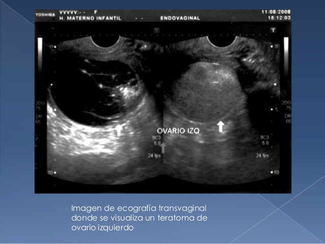 Teratoma Ovarico Teratoma Ovarico