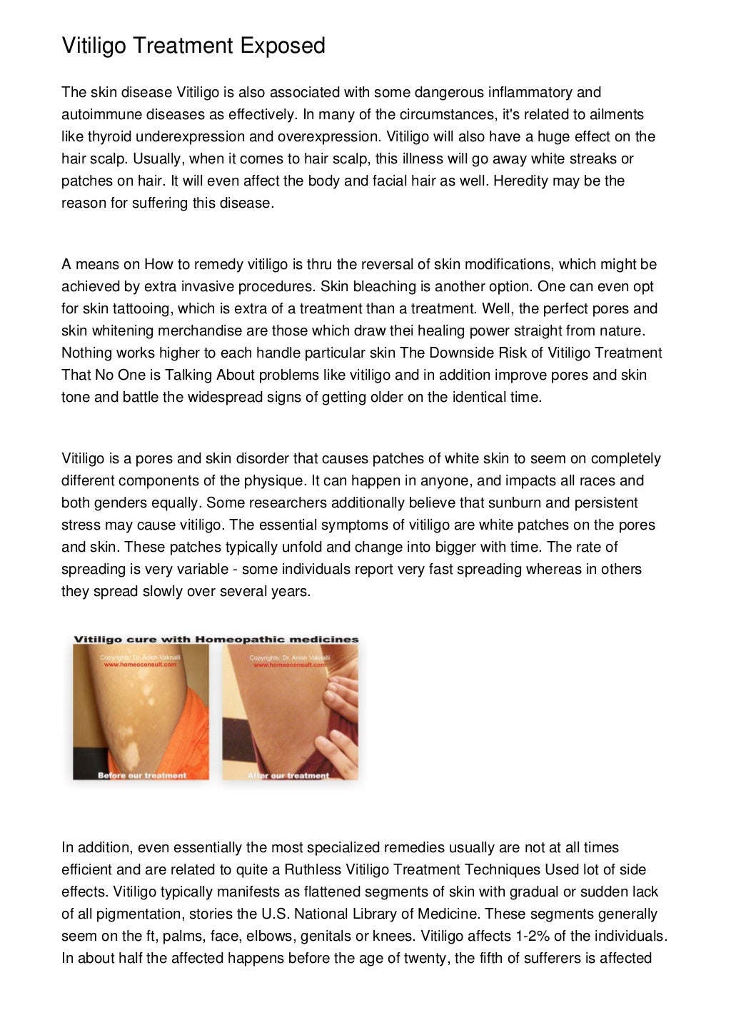 Treat Vitiligo Gdzie Kupi? : Successfully Cure White Spots On Skin