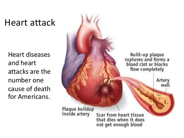 stroke prevention clinic edmonton ab small stroke at younger age
