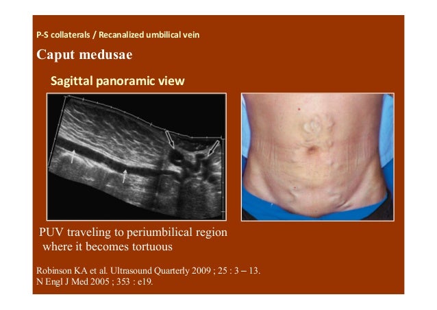 The diseased liver ..a look in pretransplant evaluation