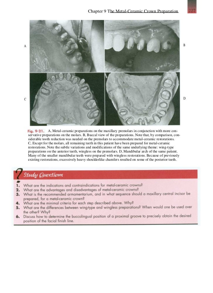 The metal ceramic crown preparation