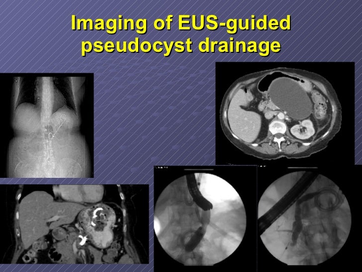 Therapeutic Eus 2008