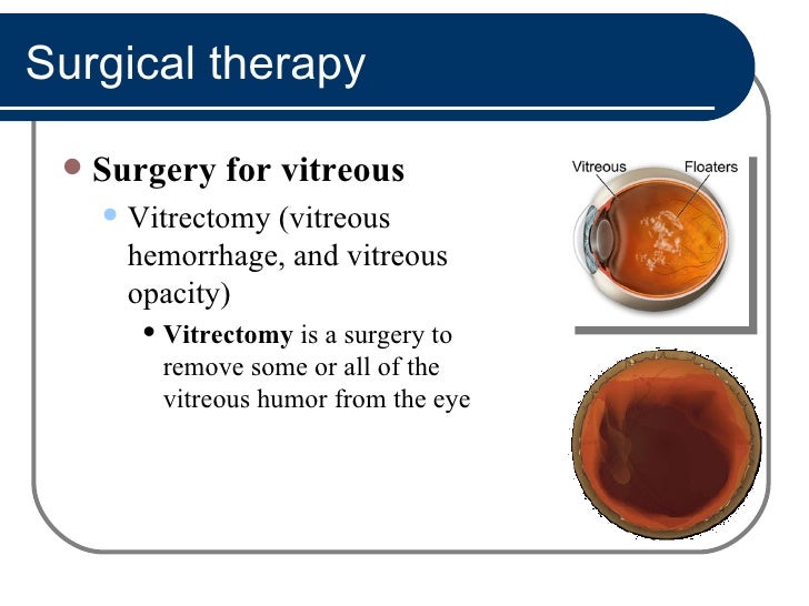  surgery for vitreous vitrectomy vitreous hemorrhage and vitreous