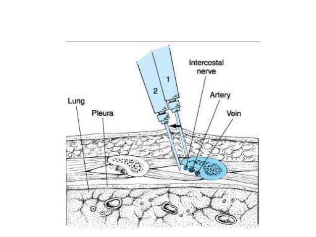 Thoracic and abdominal nerve blocks