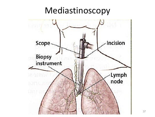 breast cancer remedy nccn