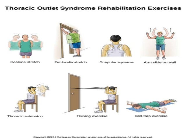 Thoracic Outlet Syndrome Thoracic Outlet Syndrome