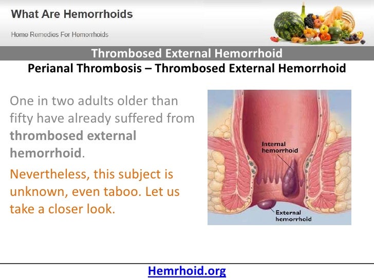 Therapy hemorrhoids holistically hemorrhoids pain