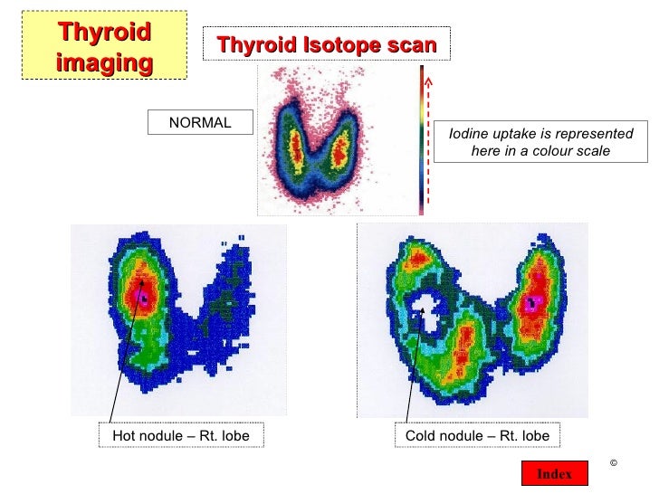 Thyroid presentation
