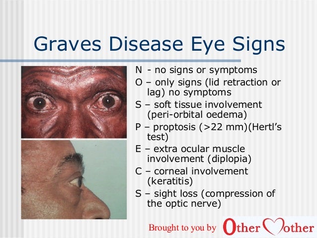 an analysis of factors and symptoms of graves disease in thyroid diseases Learn about symptoms and causes of hypothyroidism login home » endocrine disorders » thyroid diseases » hypothyroidism many factors will go into the. an analysis of factors and symptoms of graves disease in thyroid diseases Learn about symptoms and causes of hypothyroidism login home » endocrine disorders » thyroid diseases » hypothyroidism many factors will go into the.