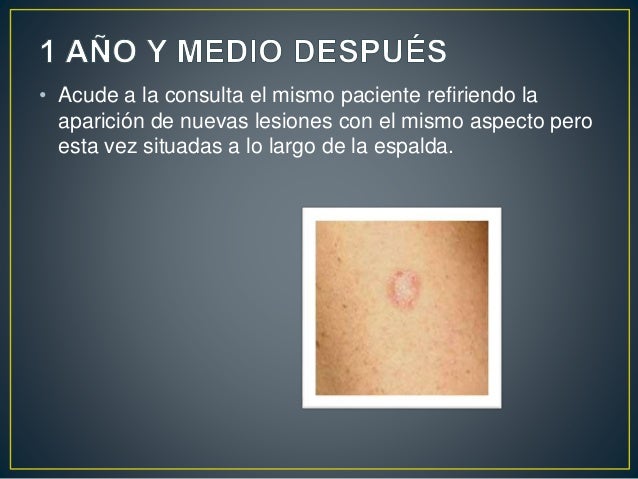 La tintura de la celidonia mayor sobre el alcohol la aplicación la psoriasis