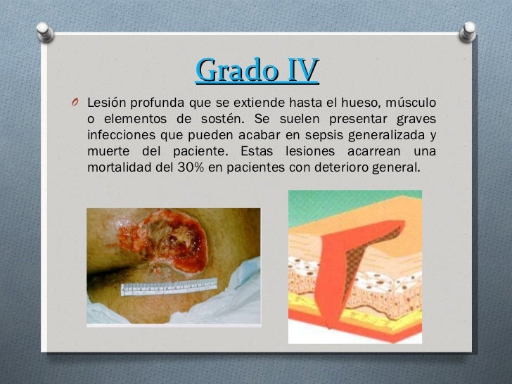 Ulceras por presión. Prevención, diagnóstico y tratamiento.