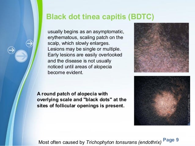 Tinea capitis: MedlinePlus Medical Encyclopedia