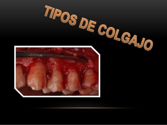 Tipos de colgajo