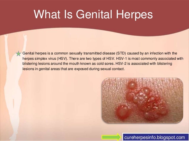 Genital Herpes in Women Symptoms and Treatment