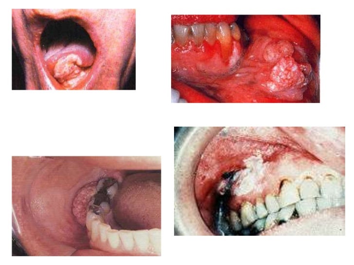 Can You Get Lung Cancer From Smoking Weed Can You Get Lung Cancer From Smoking Weed
