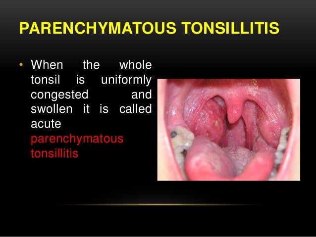Chronic Tonsillitis Adults Chronic Tonsillitis Adults
