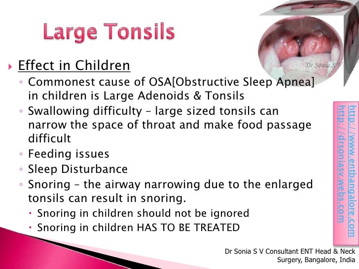TonsillitisENT Doctor Bangalore