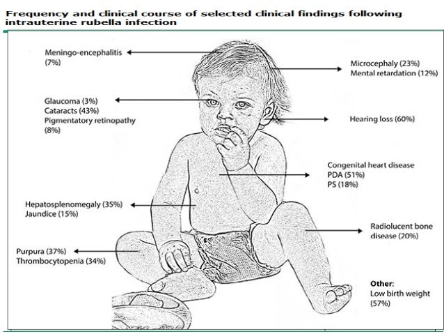 Congenital rubella syndrome symptoms in adults