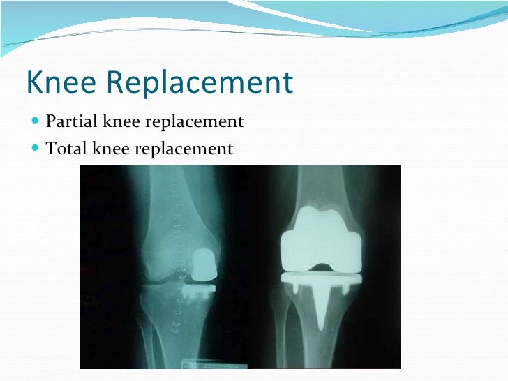 Total knee replacement (tkr) ppt
