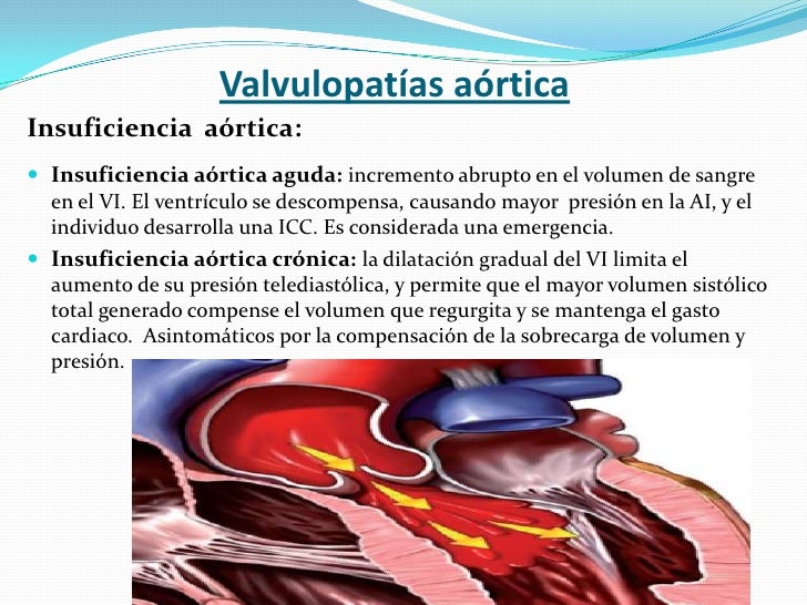 Valvulopatía aórtica. Pruebas funcionales