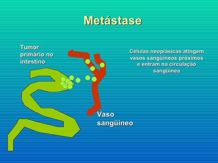 radiothérapie et most cancers du foie metastase most cancers de prostata